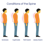 3 Spine Conditions and Their Treatments
