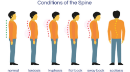 3 Spine Conditions and Their Treatments