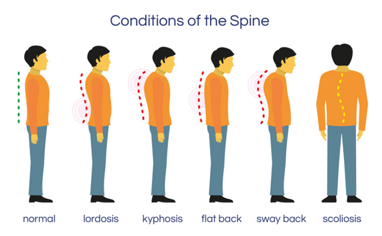 3 Spine Conditions and Their Treatments