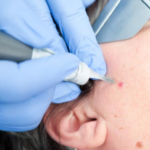 FAQs About Mohs Surgery