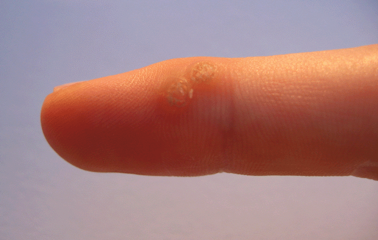 Unusual Causes of Warts You Might Not Know