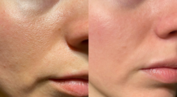 Lifestyle Changes After AAA Repair Surgery