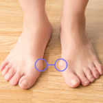How Bunions Affect Balance and Mobility Over Time