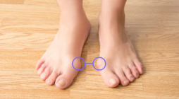 How Bunions Affect Balance and Mobility Over Time