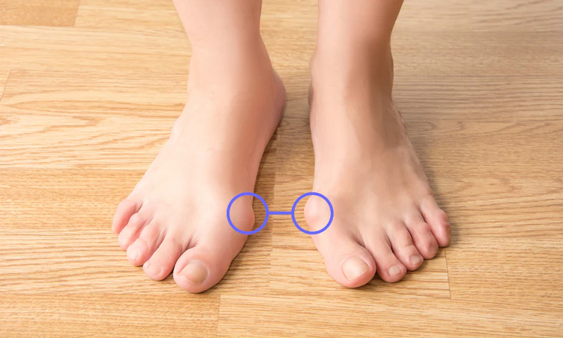 How Bunions Affect Balance and Mobility Over Time