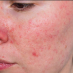 Understanding Rosacea: Causes, Symptoms, and Treatments