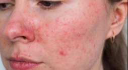 Understanding Rosacea: Causes, Symptoms, and Treatments