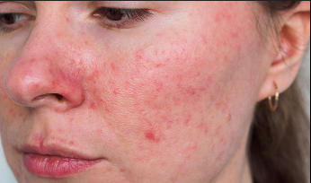 Understanding Rosacea: Causes, Symptoms, and Treatments
