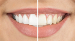 How to Achieve a Brighter Smile at Home