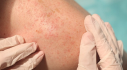 How Dermatologists Treat Common Skin Conditions
