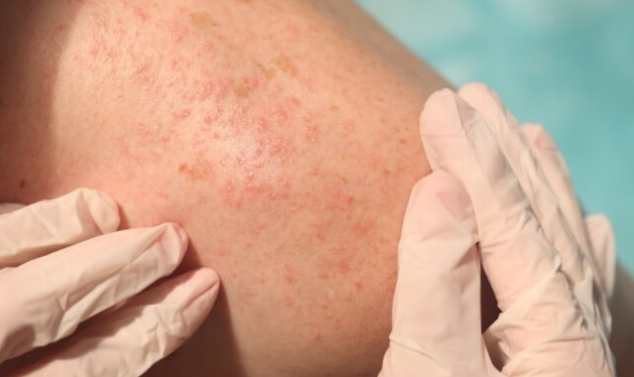 How Dermatologists Treat Common Skin Conditions