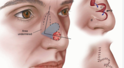 Mohs Surgery: Minimizing Scarring and Maximizing Results