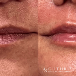 Facial Fat Grafting vs. Fillers: Which Is Right for You?