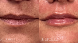 Facial Fat Grafting vs. Fillers: Which Is Right for You?