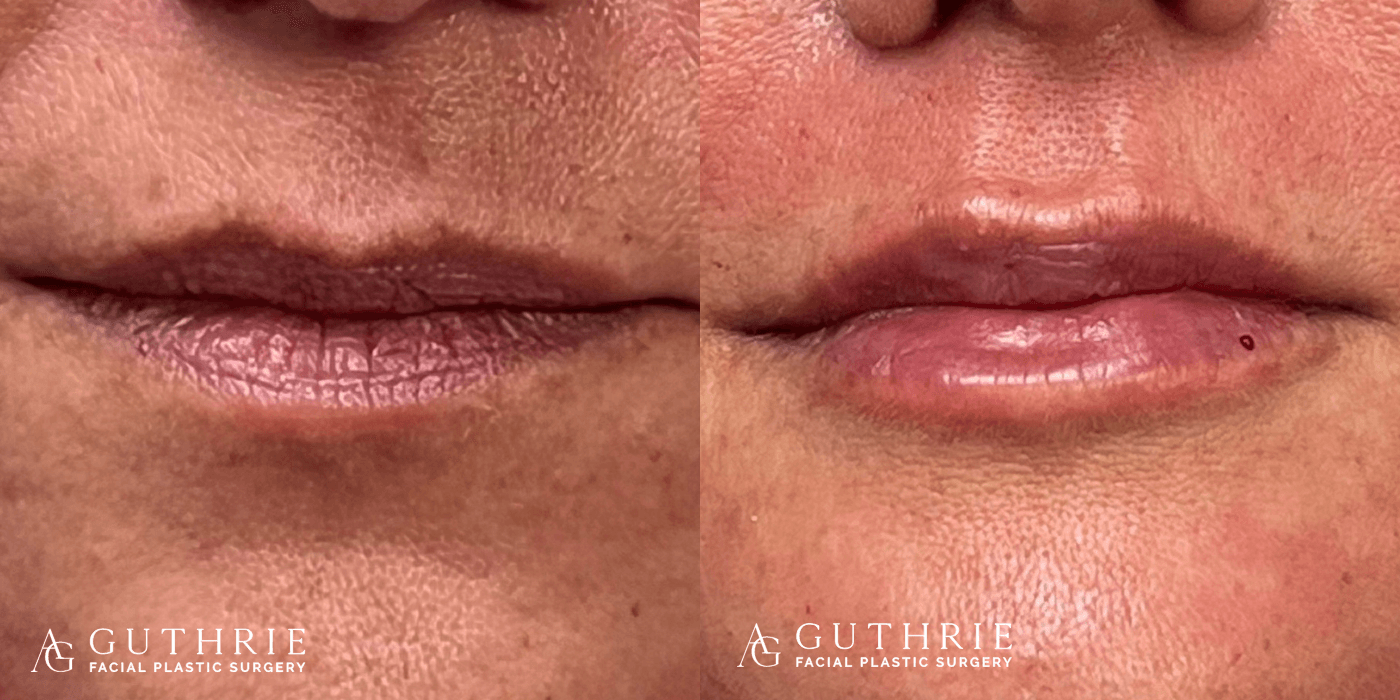 Facial Fat Grafting vs. Fillers Which Is Right for You