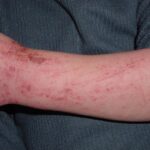 FAQs About Allergy Treatments