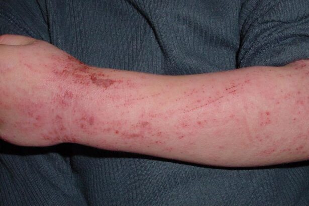 FAQs About Allergy Treatments