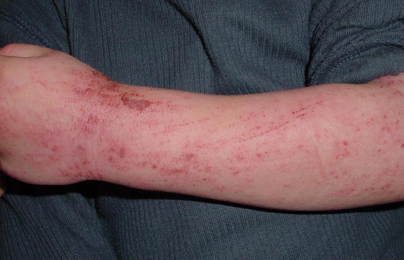 FAQs About Allergy Treatments