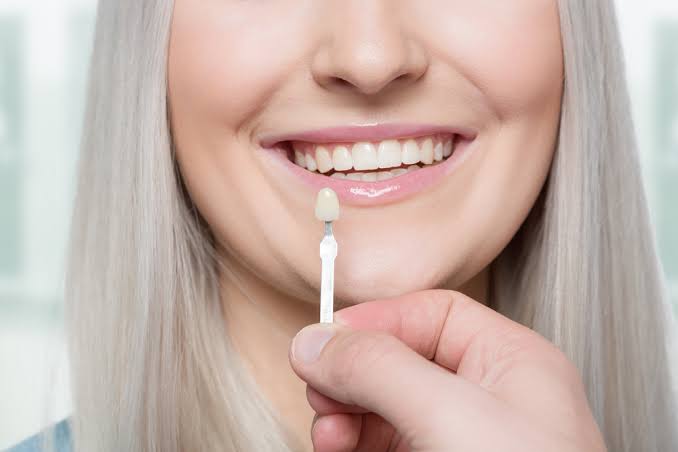 How Does a Cosmetic Dentist Place Crowns and Veneers?